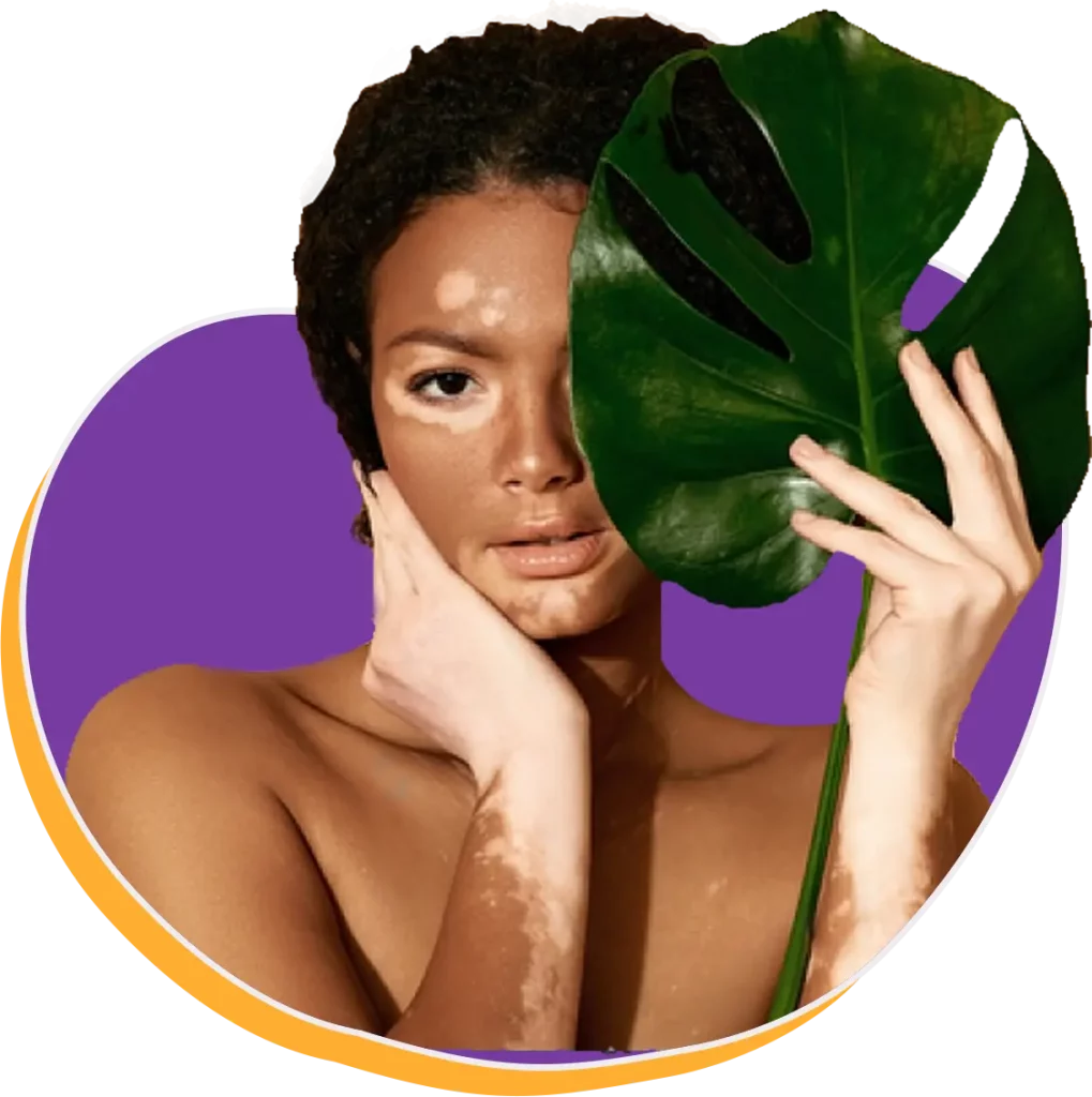 Image femme vitiligo pour site web salon SIBCA